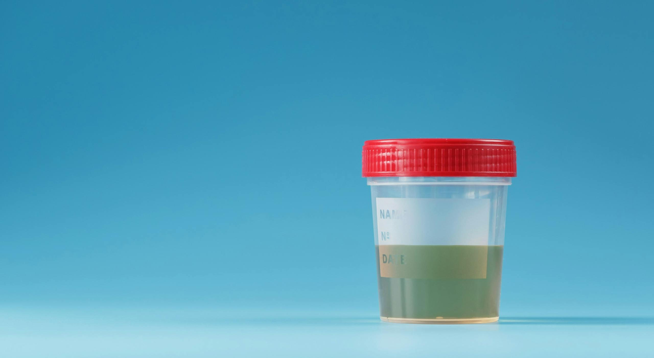 I’m Not On A Ketogenic Diet So Why Are There Ketones In My Urine?